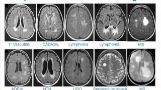 MRI Uses in MS [upl. by Publius]